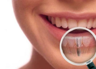 Jak dbać o implanty stomatologiczne?